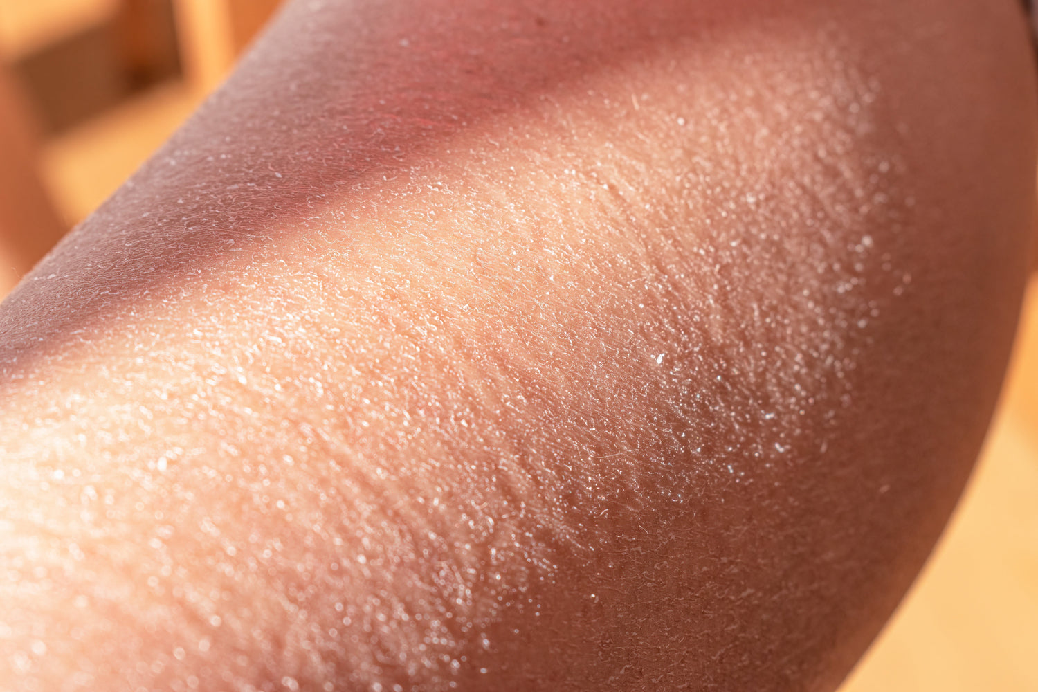 Why Is My Skin So Dry? Causes, Prevention & How to Nourish Your Skin Back to Health